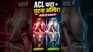 Is Surgery the Only Option After an ACL Tear? 🤔 | Dr Tarun Duggal