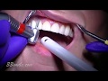Replacing old porcelain dental veneers before and after