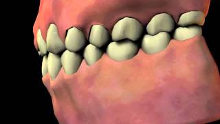 Gingival Hyperplasia
