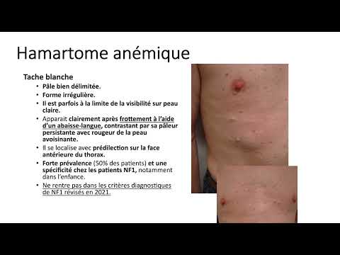 Journées Neurofibromatoses Rennes - Présentation du centre de compétences de Rennes