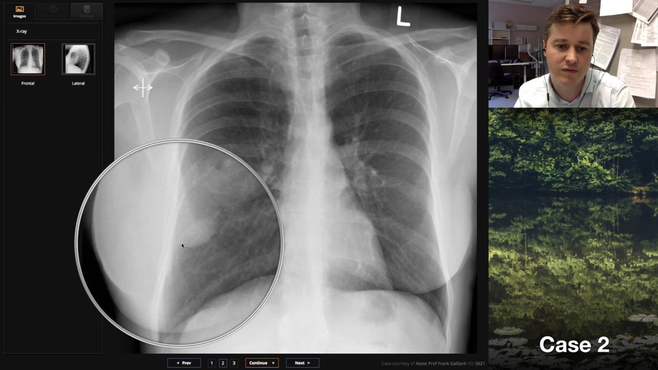 Isolation tutorial: Chest x-ray with Andrew Dixon - YouTube