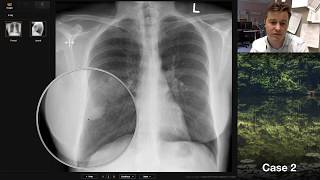 Isolation tutorial: Chest xray with Andrew Dixon