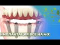 Имплантация ВСЁ-НА-4☘️