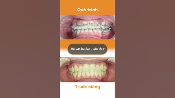 Hành trình LỘT XÁC nhờ niềng răng của Thanh Thảo