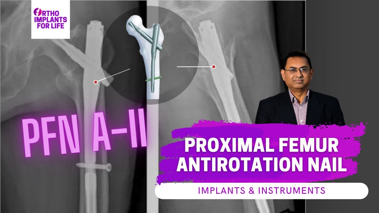 Proximal Femoral Nailing System | PFN | IMPLANTS & INSTRUMENTS - YouTube