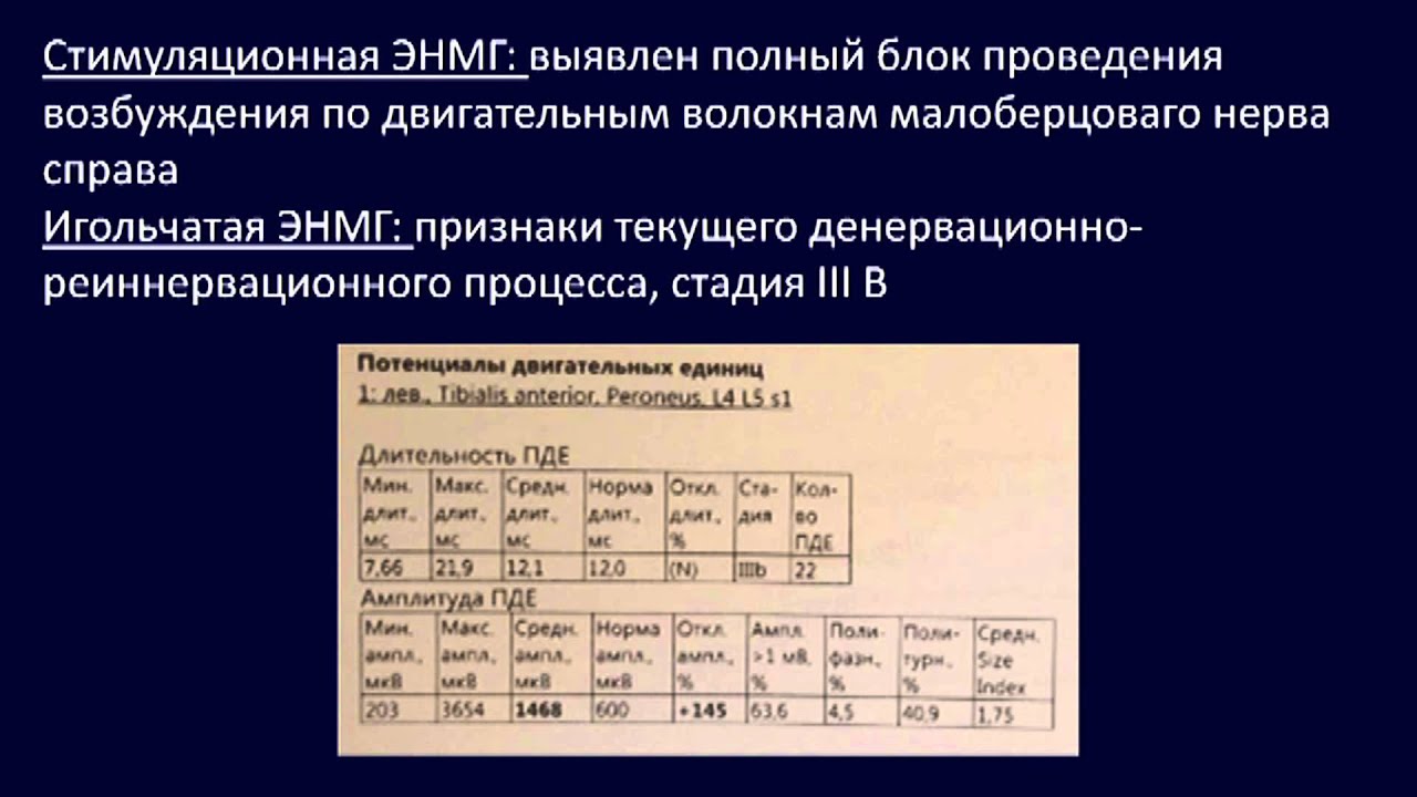 Мультифокальная моторная невропатия