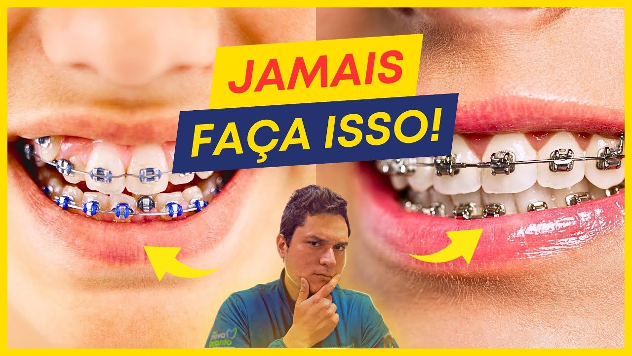 7 COISAS que você JAMAIS DEVE FAZER enquanto usa APARELHO ORTODÔNTICO.