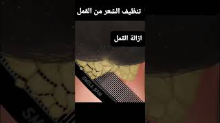 ازالة القمل #راحة_نفسية #shorts