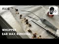 538 - Whopper Ear Wax Removal