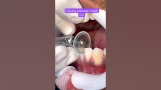 IPR BRACES, Orthodontics Treatment