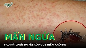 Ngứa Sau Khi Sốt Xuất Huyết Có Nguy Hiểm Không? | SKĐS