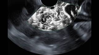 PART I - Aplio i800 EUS Processor for Olympus Echoendoscopes: The Dawn of a New Era