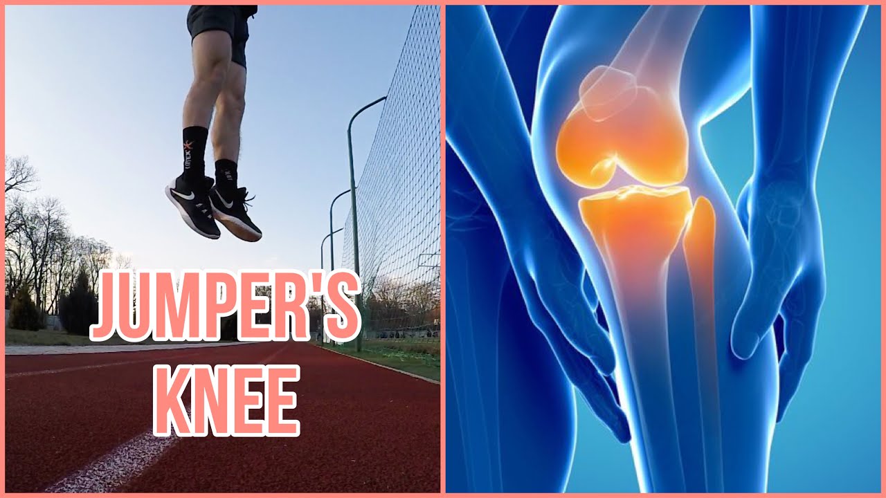 Knee Pain From Volleyball How To Fix It YouTube Knee Pain From Volleyball How To Fix It YouTube