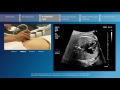 Key screening views of the fetal heart - Part 3 - 4-chamber view