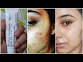 Best Cream to Remove pimples, pimple marks, Acnes, Acne Scars, Tiny bumps, fungal acne, cystic acnes