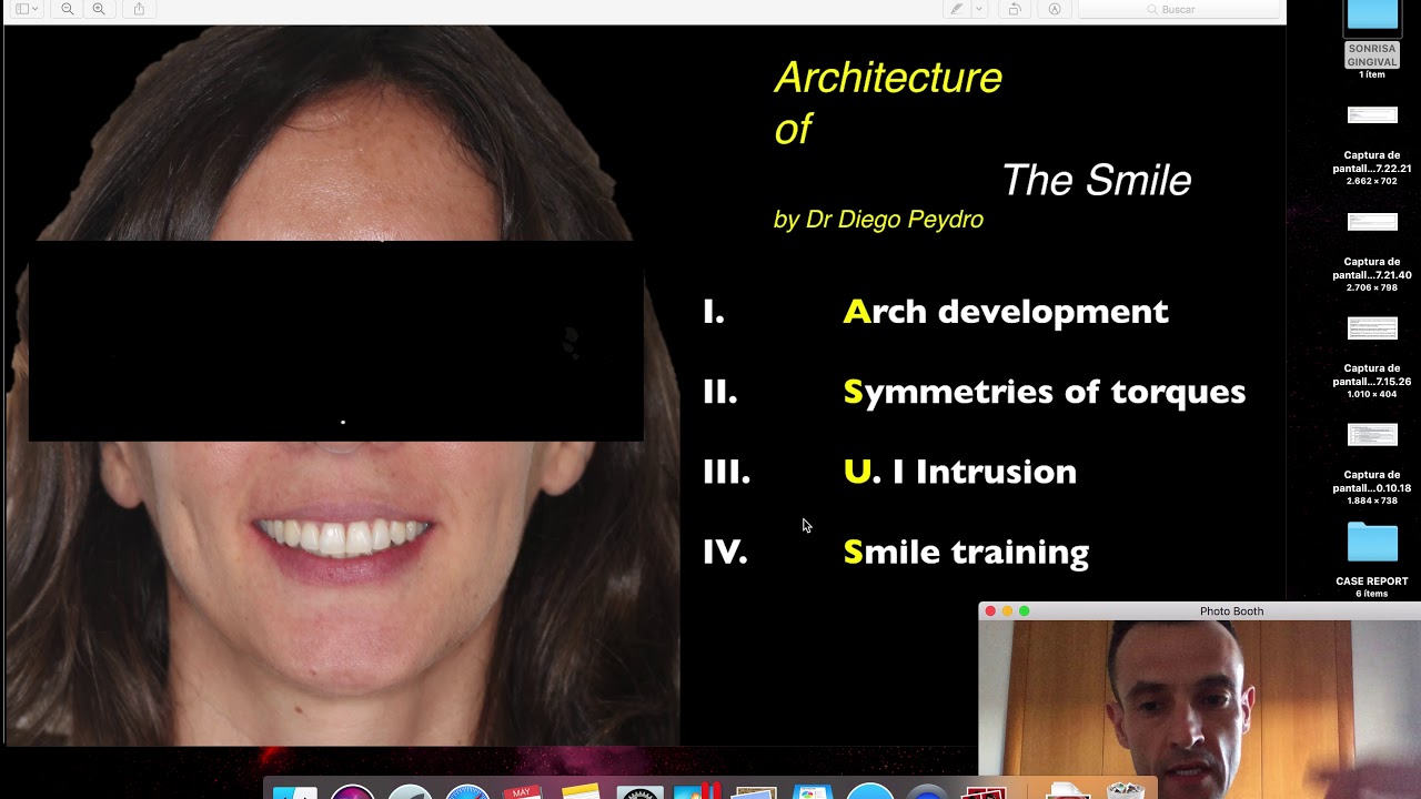 Gummy smile. Solved with TADS and aligners.