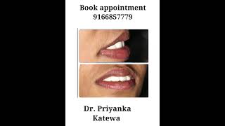 Smile Design Treatment For Long Teeth