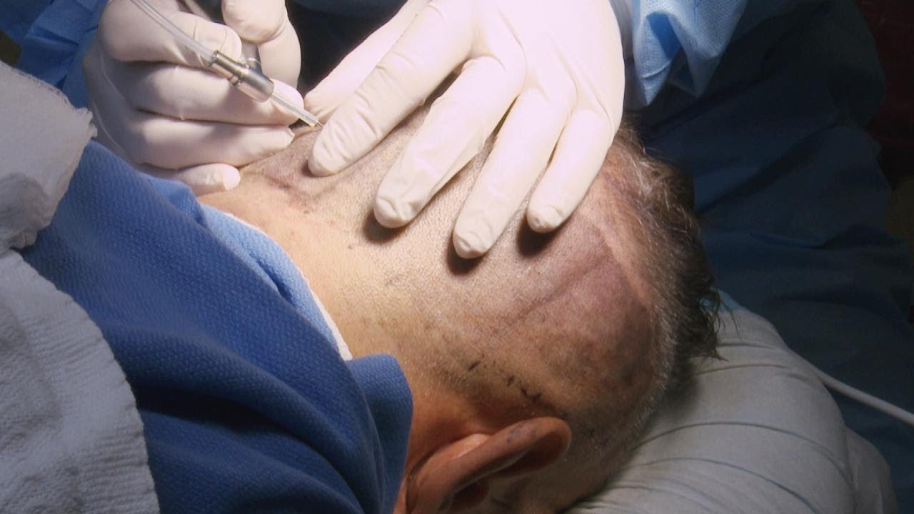 physical education What Happens during a Hair Transplant?