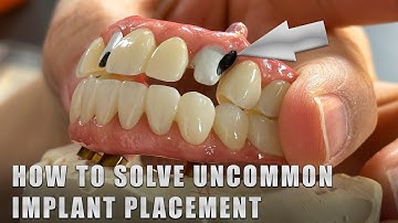 How to solve Uncommon Implant Placement