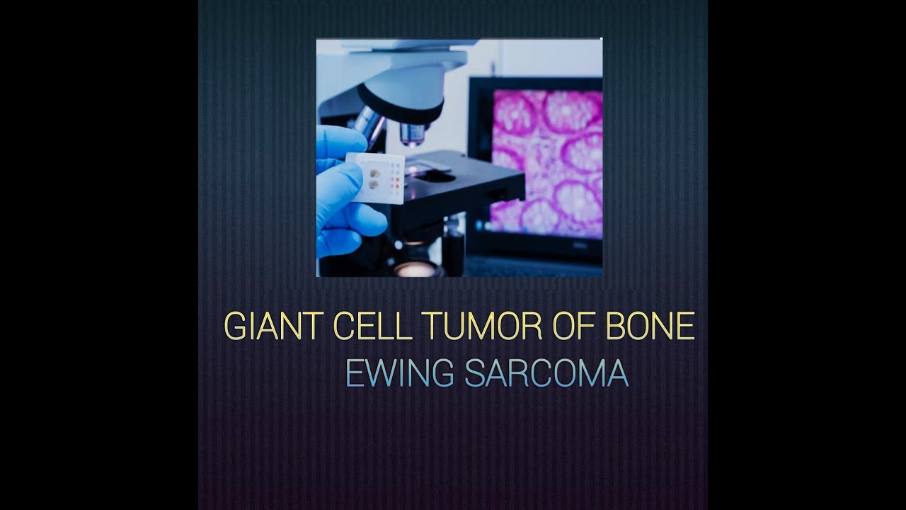 Giant cell tumor of bone & Ewing sarcoma #giantcelltumor #ewingsarcoma ...