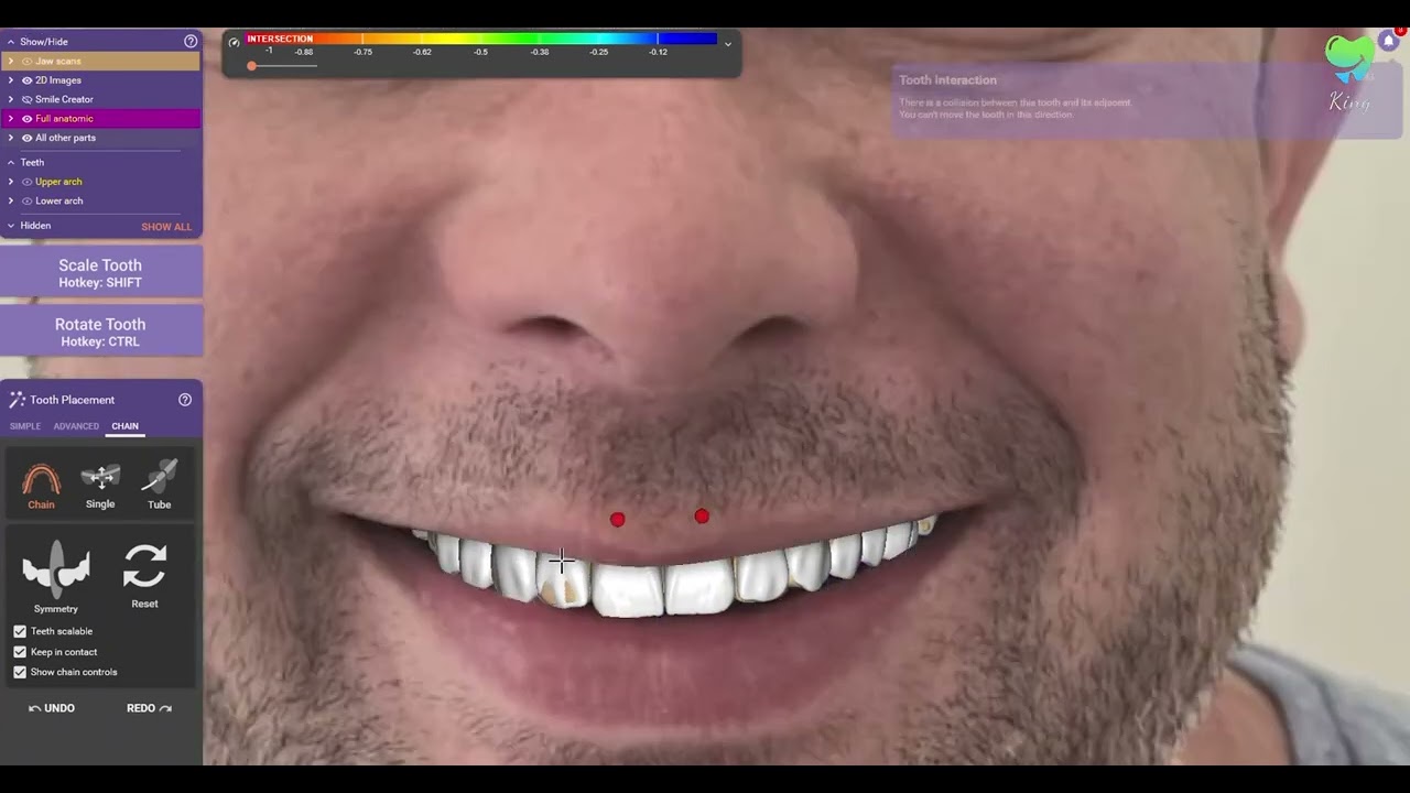 Mockup Smile Design Tutorial in Exocad Smile Creator