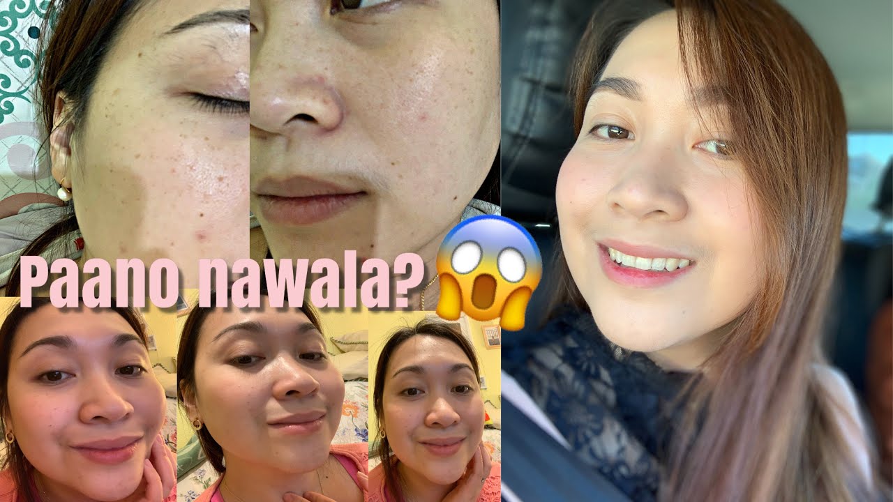 SOLUSYON SA PIMPLES & SCARS (NATURAL REMEDY) | ayaesguerra