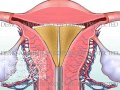 NovaSure Endometrial Ablation with Post-Op Bleeding