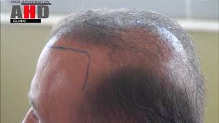 Bad Hair Transplant Dr  Hakan Doganay, Repair