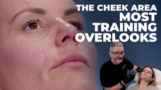 Anterior Cheek Filler Tutorial: The Area Most Training Overlooks