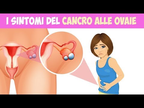 Video: Cancro Ovarico - Sintomi, Fasi E Trattamento Del Cancro Ovarico Nelle Donne, Prognosi Della Malattia