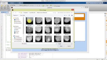 Breast Cancer Detection using Image Processing (Segmentation) Matlab Project with Code