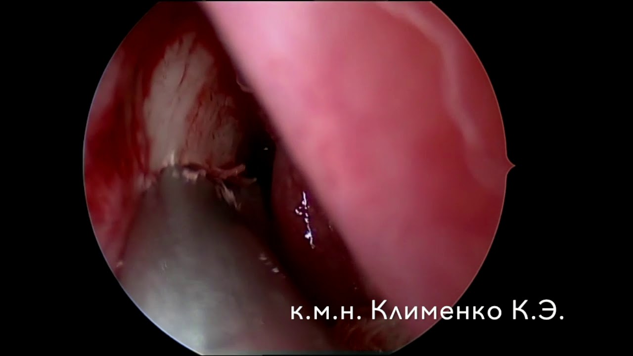 Дакриоцистит