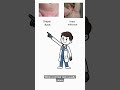 Diaper Rash vs Yeast Infection