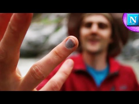 Smashed Fingernail Blood Draining: DIY Surgery