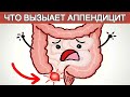 Что вызывает аппендицит. Симптомы. Удаление.