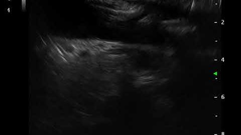 Video 17 Scanning Superior Mesenteric Artery from Duodenum