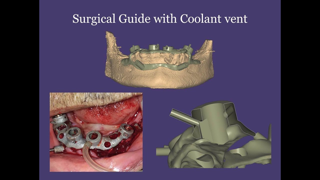 Exocad Surgical Guide with Coolant vent YouTube