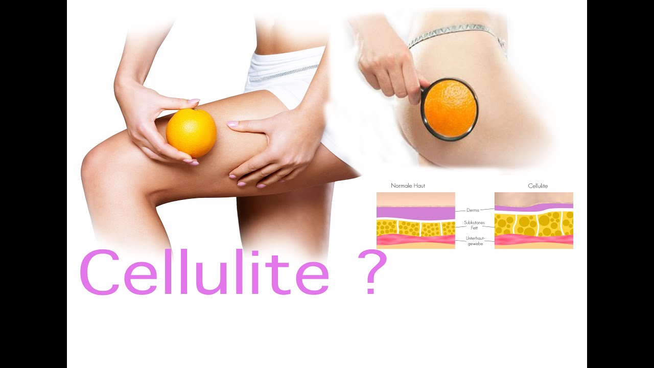 Cellulite Schnell Bekämpfen Cellulite Schnell Bekämpfen