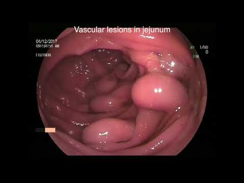 KLIPPEL-TRENAUNAY SYNDROME?