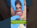 Instant smile transformation with zirconia crowns dr srishti bhatia