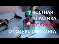 Отличия костной пластики от синус-лифтинга