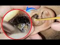 Extreme Doctor ASMR Horror: Deep Earwax Removal Gone Too Far | Real Sounds | EP 219