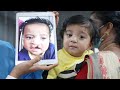 Old Cleft lip Baby came back for Palate repair surgery - Consultation