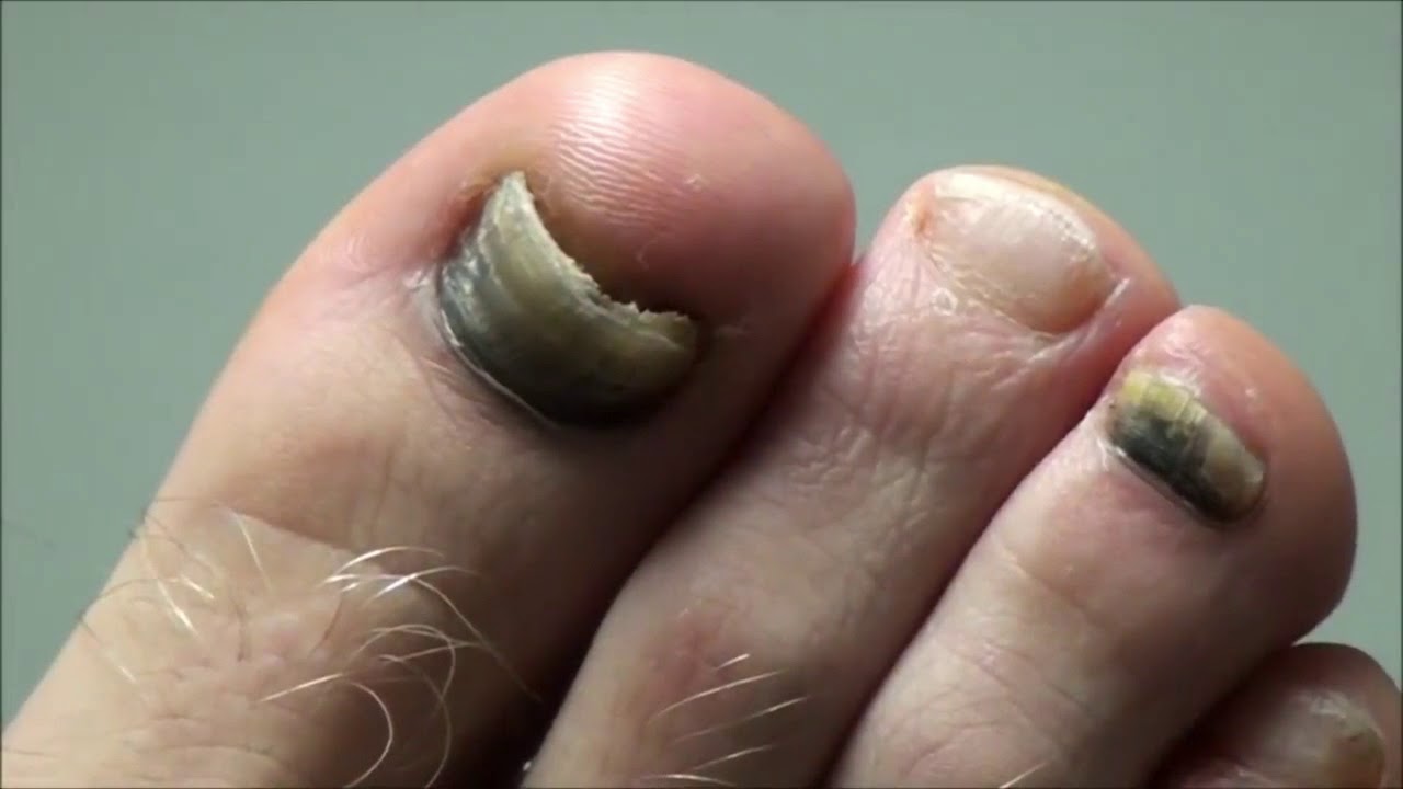 Dr. Nail Nipper vs Soccer Nails! Nail Clipping! - YouTube