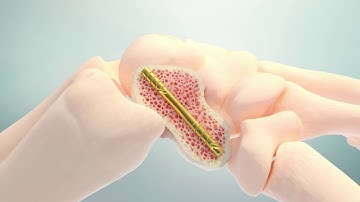 OsteoCentric Technologies Headless Compression System