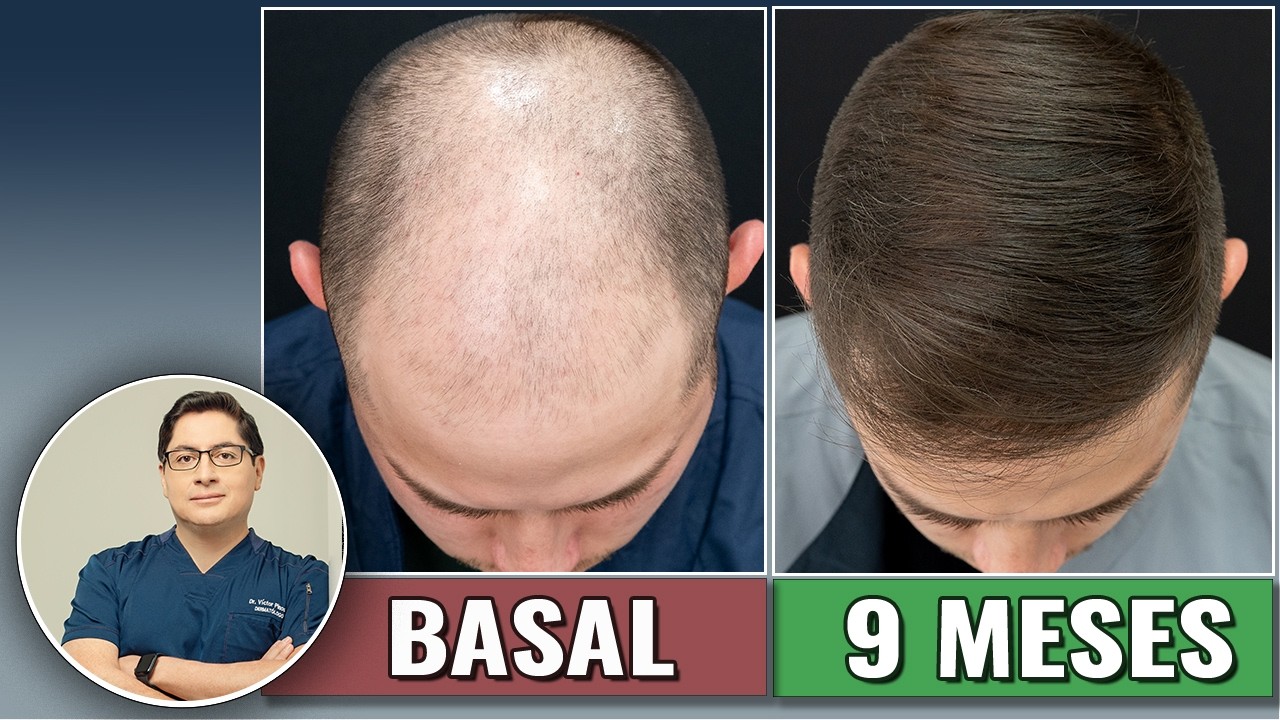 🔴 SIN TRASPLANTE!. ¿Cómo este paciente RECUPERÓ SU CABELLO?