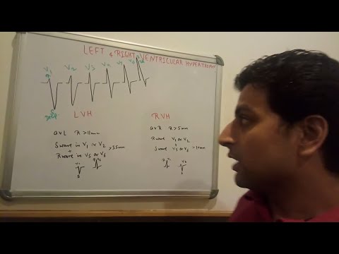 left-ventricular-hypertrophy-ecg-interpretation-lecture-by-dr.hemant