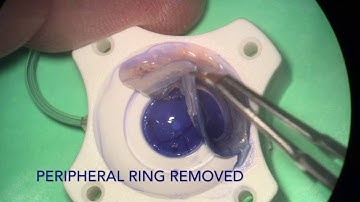 DMEK Liquid bubble dissection