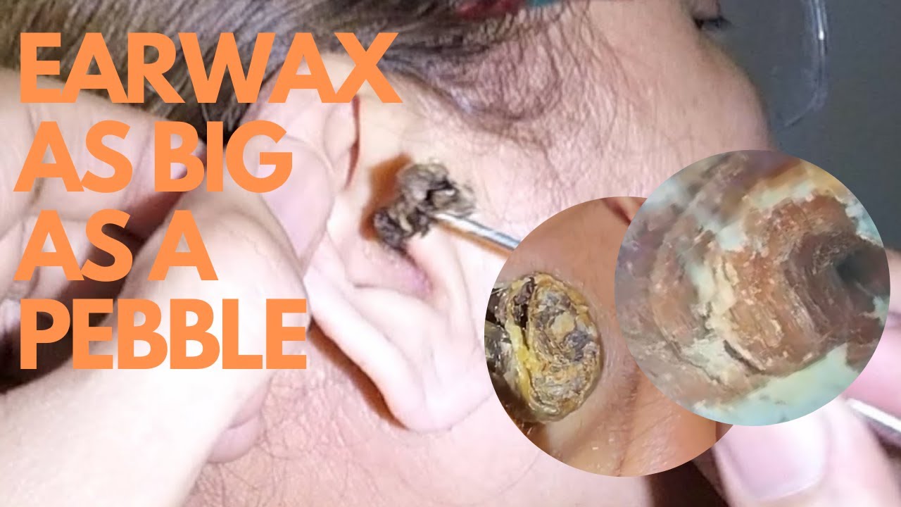 Earwax as Big as a Pebble – The Moment of Removal Will Give You Chills ...