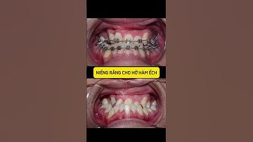 QUÁ TRÌNH NIỀNG RĂNG CHO NGƯỜI HỞ HÀM ẾCH